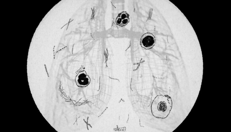 An illustration shows tuberculosis bacteria from a microscope overlayed on top of a diagram of lungs.