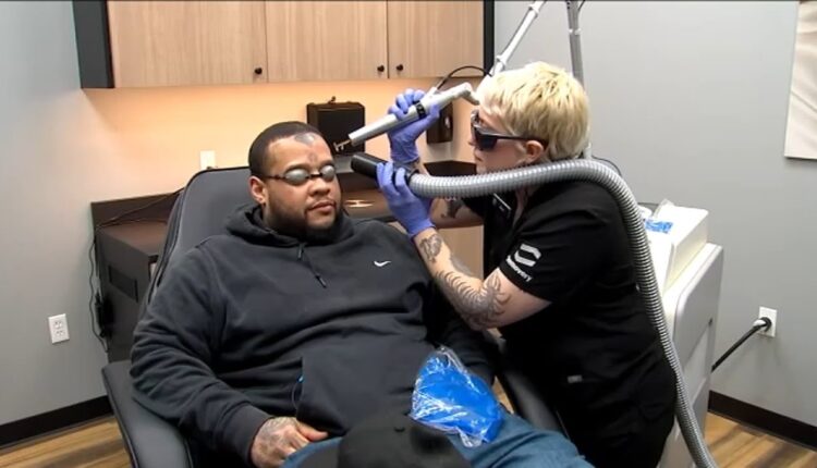 Removery: A tattoo removal service offering a new lease on life