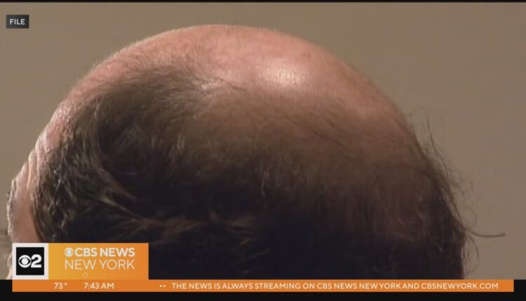 On Call with Dr. Kumar: Tips on how to prevent hair loss